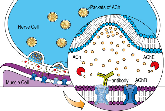 Myasthenia gravis occurs when the immune system makes antibodies that destroy the ACh receptor (AChR), a docking site for the nerve chemical acetylcholine (ACh). Some treatments block acetylcholinesterase (AChE), an enzyme that breaks down ACh, while others target the immune system.