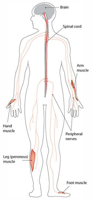 CMT causes degeneration of the peripheral nerves, leading to muscle weakness in the body’s extremities.
