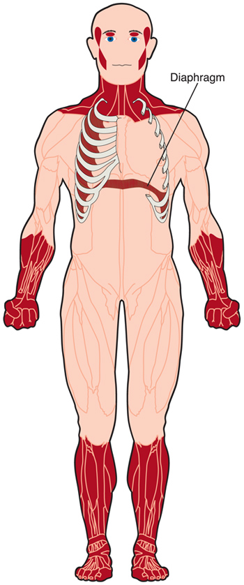 Weakness and wasting (shrinking) of voluntary muscles in the face, neck and lower arms and legs are common in type 1 myotonic dystrophy. Muscles between the ribs and those of the diaphragm, which moves up and down to allow inhalation and exhalation of air, also can be weakened.