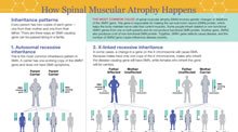 How Spinal Muscular Atrophy Happens